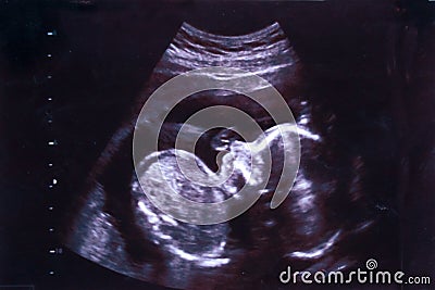 Ultrasound image of a human embryo between 15 and 20 weeks Stock Photo