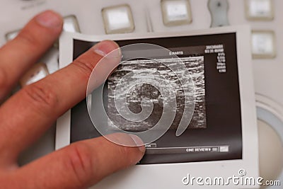 Ultrasound photo - Metastatic lymph node in breast cancer Stock Photo