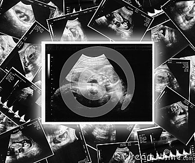Ultrasound picture of a child Stock Photo