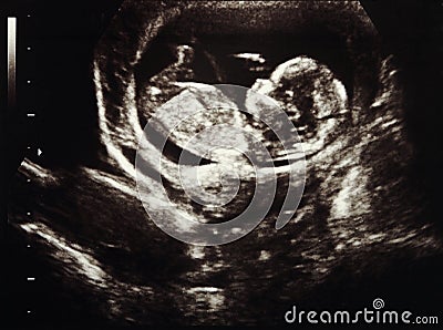 Ultrasound pregnancy Stock Photo