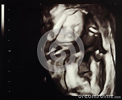 Ultrasound pregnancy Stock Photo