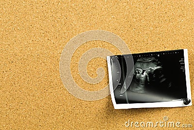 Ultrasound pregnancy photo on cork board. Baby fetus photo as a first pregnancy sticky note Stock Photo