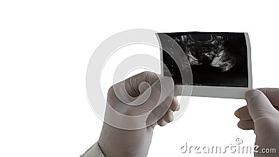 Ultrasound of the prostate in the hands of a doctor, a picture of a male prostate Stock Photo