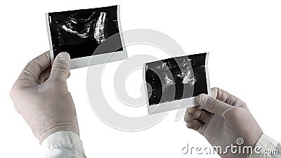 Ultrasound of the prostate isolated on white background, picture of the male prostate at the doctor`s hands. Stock Photo