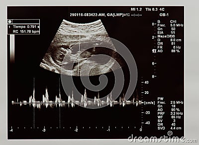 Ultrasound scan of future baby Stock Photo