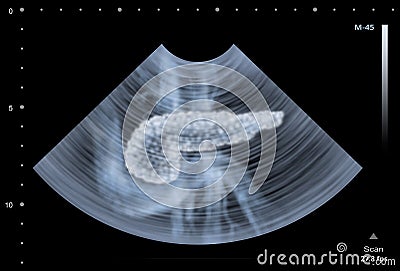 Ultrasound scan of human Pancreas Stock Photo