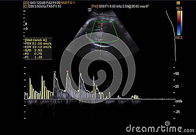 Ultrasound scan medical imaging of abdomen diagnosing gallstones Stock Photo