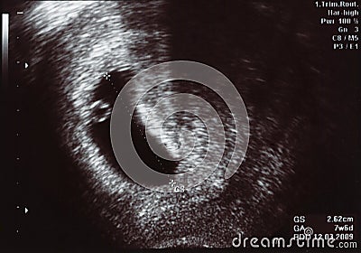 Ultrasound Scan One Month Stock Photo