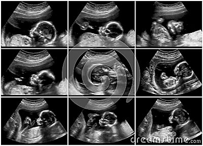 Ultrasound scans collage during pregnancy at the end of third mo Stock Photo