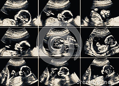 Ultrasound scans collage during pregnancy at the end of third mo Stock Photo