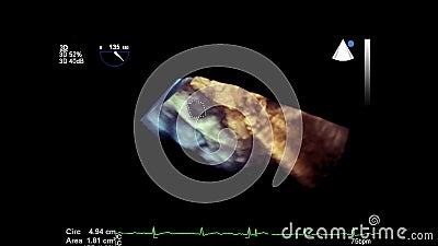 Ultrasound transesophageal examination of the heart. Stock Photo