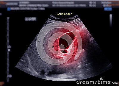 Ultrasound upper abdomen showing gallbladder for diagnosis gallbladder stone Stock Photo