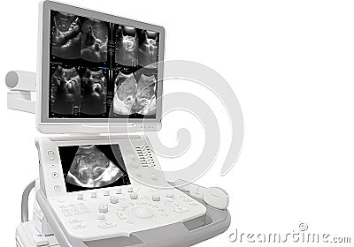 Ultrasound whole abdomen showing body and antrum with luminal narrowing of gastic antrum.Liver,GB,CBD,pancreas,spleen and both Stock Photo