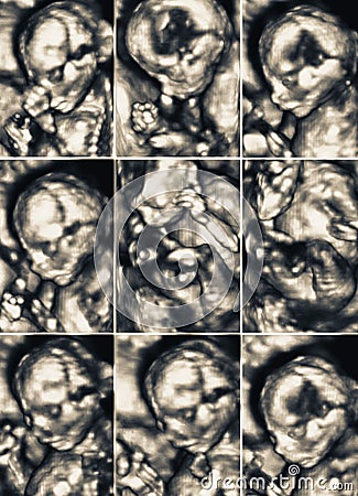 Ultrasound of a young fetus inside the womb. Collection of nine Stock Photo