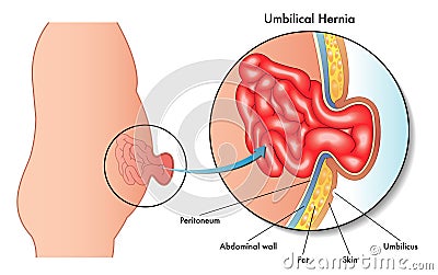 Umbilical hernia Vector Illustration