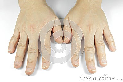 Unattractive hands on white background Stock Photo