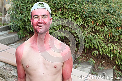 Unconscious sunburned man with horrible skin irritation Stock Photo