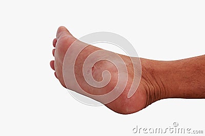 The under foot is a fungal infection. It is an actual skin Stock Photo
