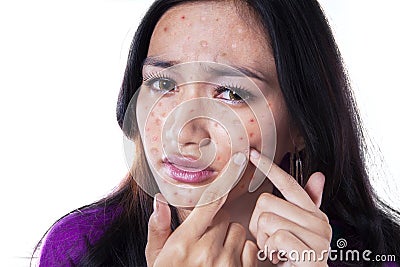 Unhappy girl touching pimple on cheek Stock Photo