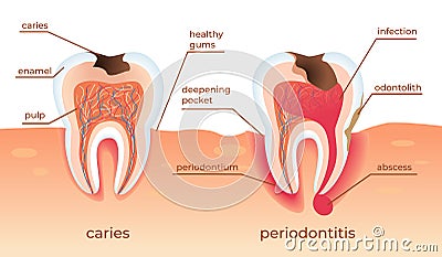 Unhealthy Teeth Stand in Raw in Gums. Tooth Decay. Vector Illustration