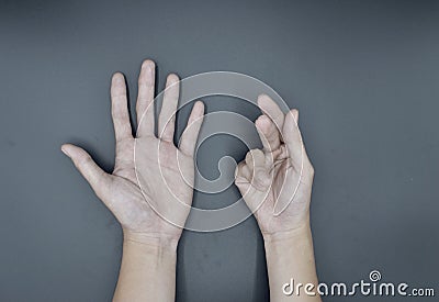 Unilateral Dupuytrenâ€™s contracture in Asian young man. Unilateral hand deformity. Abnormal fingers flexion Stock Photo