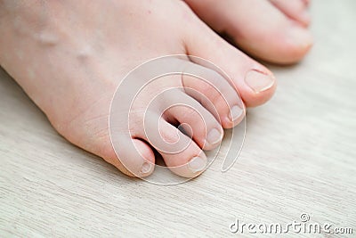 unusual foot. very small little finger on the leg. orthopedic abnormalities. Stock Photo