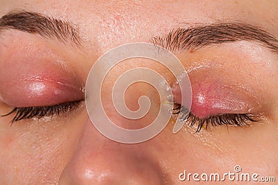 Upper eyelid infection - chalazion Stock Photo