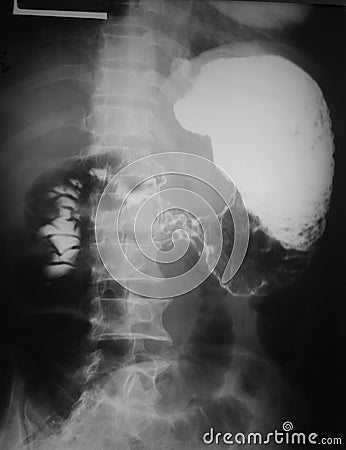 Upper gastro-intestinal (UGI) study of a 55 years old man, demonstrated post jejunum obstruction of contrast media. Stock Photo