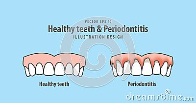 Upper healthy teeth & Periodontitis illustration vector Vector Illustration