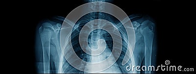 Upper part x-ray image Stock Photo