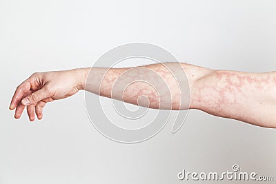 Upright arm with red skin capillary network Stock Photo