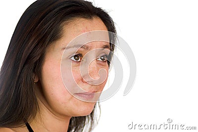 Upset woman with acne Stock Photo