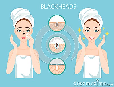 Upset woman with female facial skin problem needs to care about: infographic of clogged nose pores and blackheads. Stages of tr Vector Illustration