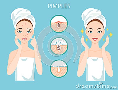 Upset woman with female facial skin problem needs to care about: infographic of pimples and stages of their treatment and clear Vector Illustration