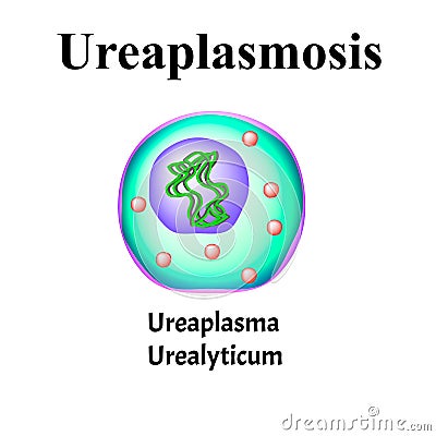 Ureaplasma urealyticum. Bacterial infections Ureaplasma. Sexually transmitted diseases. Infographics. Vector Vector Illustration