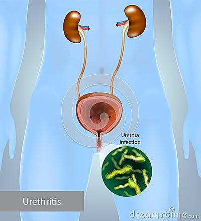 Urethritis is the inflammation of the urethra. Gonococcal urethritis. Urinary tract infection. Vector Illustration