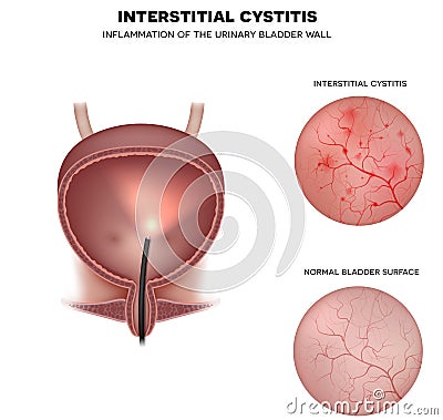 Urinary bladder lining Vector Illustration