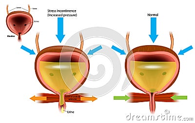 Urinary incontinence UI, also known as involuntary urination. Vector Illustration