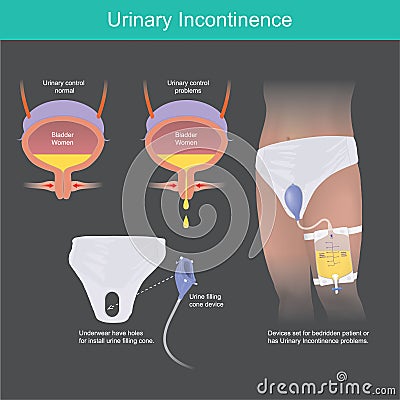 Urinary Incontinence. Urine filling cone device. Vector Illustration