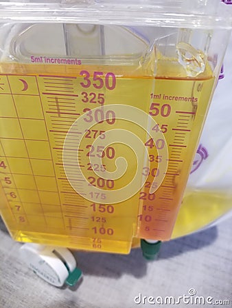 Foley catheter reservoir filled with yellow urine Stock Photo