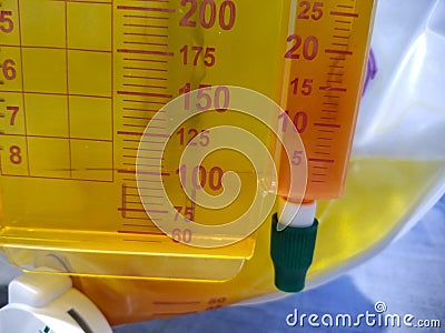 Foley catheter reservoir filled with yellow urine Stock Photo