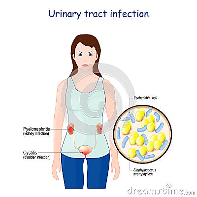 Urinary tract infection. cystitis, and pyelonephritis Vector Illustration