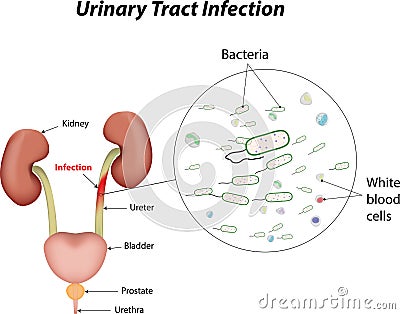 Urinary Tract Infection Vector Illustration
