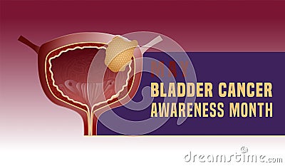 Urothelial carcinoma landscape poster. Urinary bladder cancer banner Vector Illustration