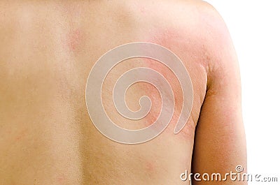 Urticaria Stock Photo