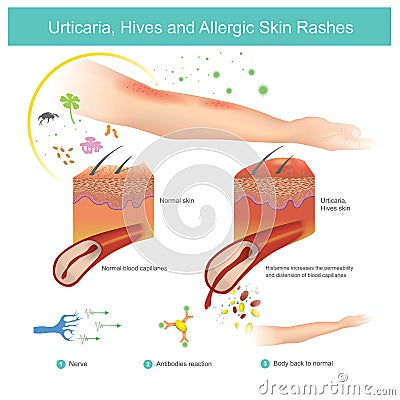 Urticaria, Hives and Allergic Skin Rashes. Illustration. Stock Photo