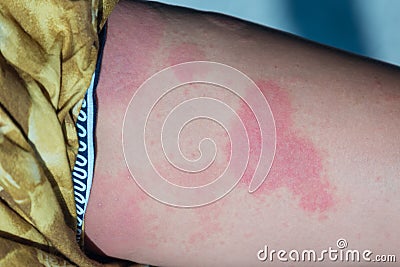 Urticaria on woman leg Stock Photo