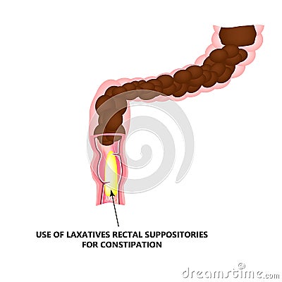 Use of laxatives rectal suppositories for constipation. Feces in colon. Infographics. Vector illustration on isolated Vector Illustration