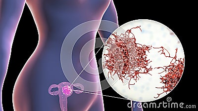 Uterine cancer, close-up view of a cancer cell Cartoon Illustration