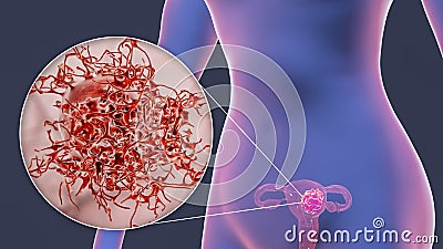 Uterine cancer, close-up view of a cancer cell Cartoon Illustration